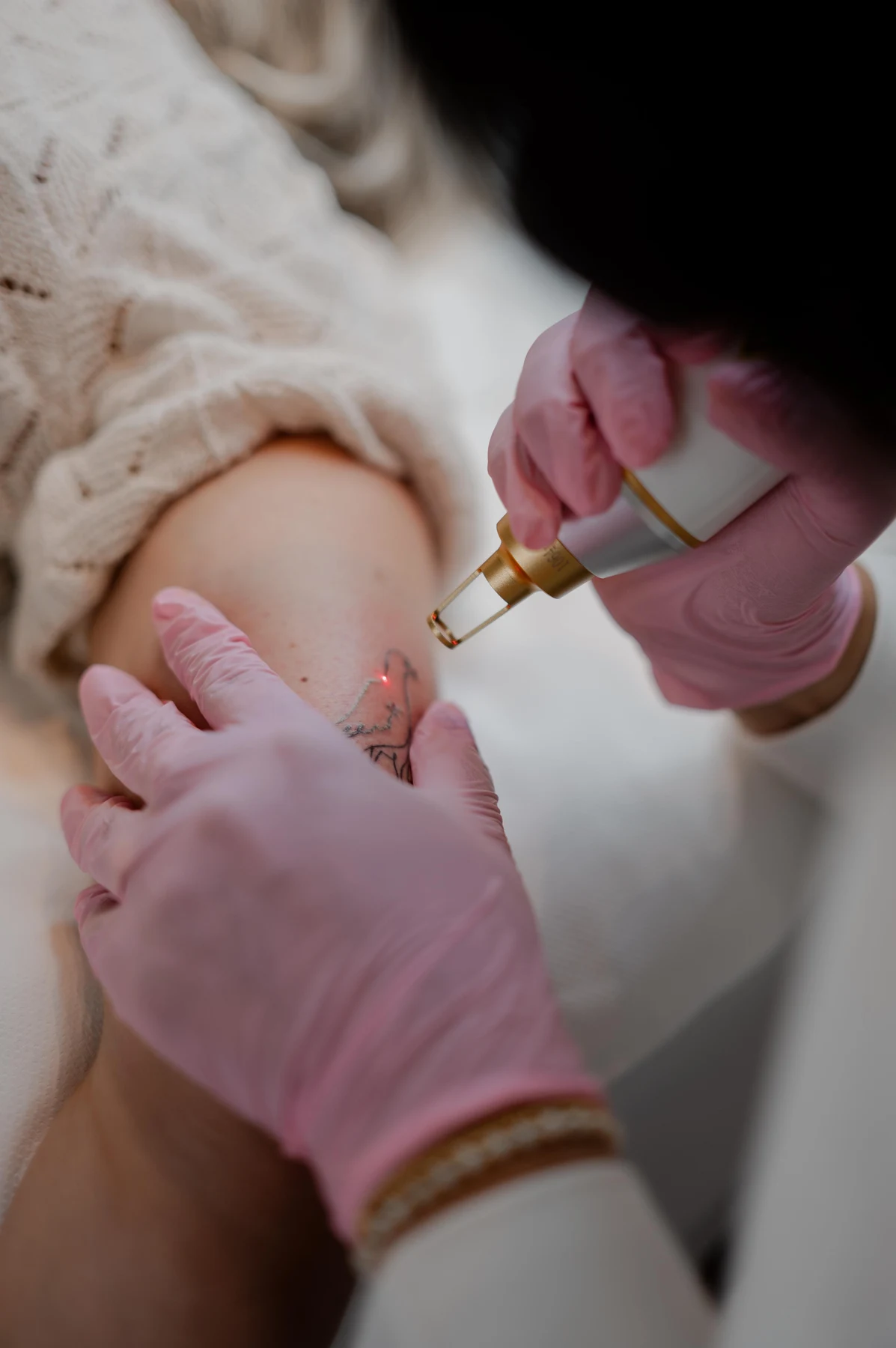 Laserbehandeling van een tatoeage in uitvoering bij By Shay